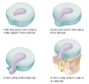 허리디스크2