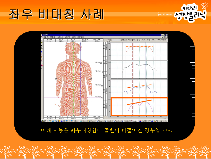 좌우 비대칭 사례