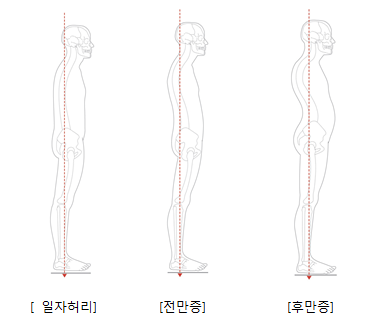 일자허리 전만증 후만증